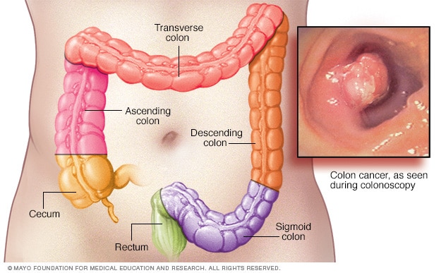 Colon cancer locations 