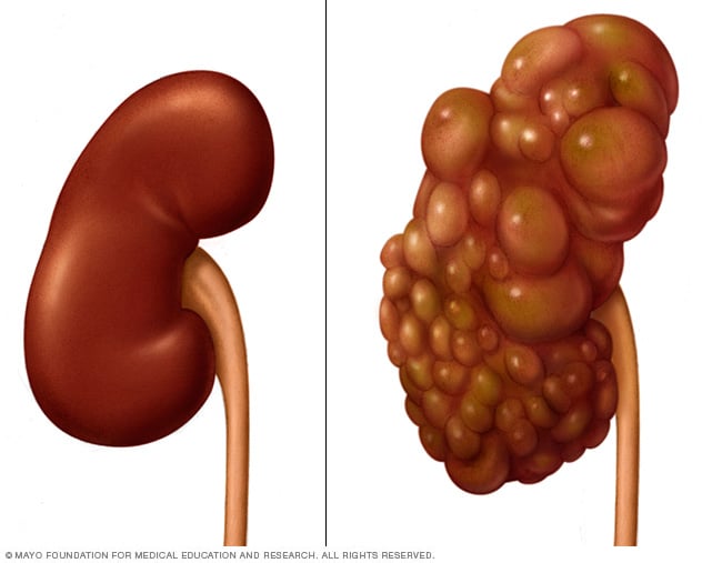 Illustration showing normal and polycystic kidneys