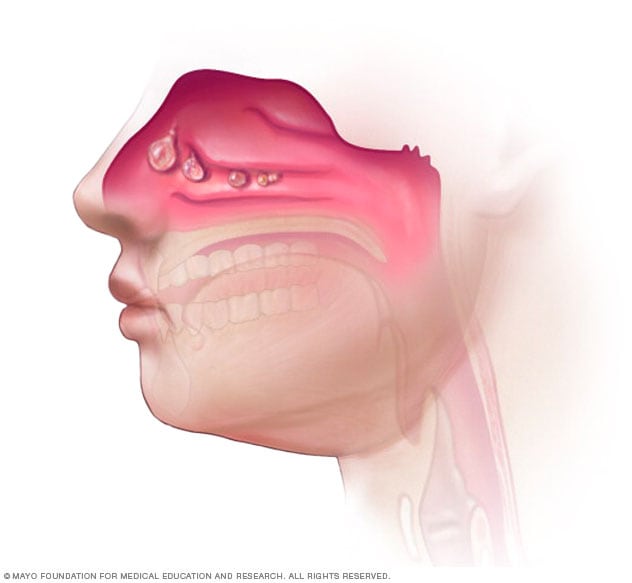 Nasal Polyps Symptoms And Causes Mayo Clinic