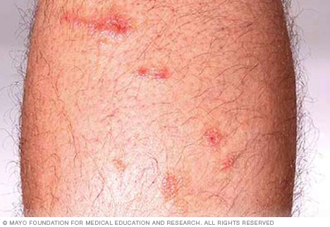 毒藤可能引起红色皮疹
