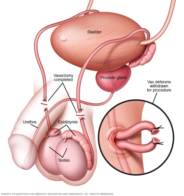 Vazectomia és prostatitis