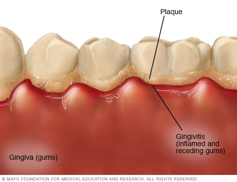 Gingivitis - Síntomas y causas - Mayo Clinic