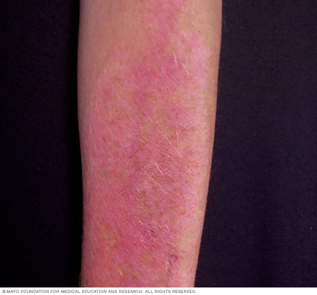 What does tanning bed rash look like