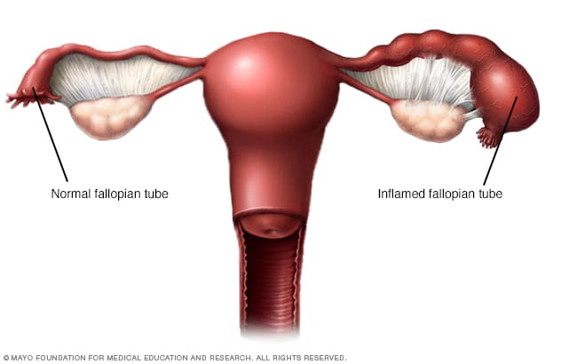 reproductive tract infection symptoms
