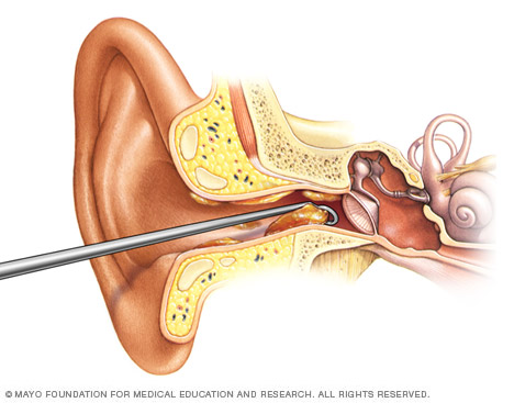 removal of impacted ear wax