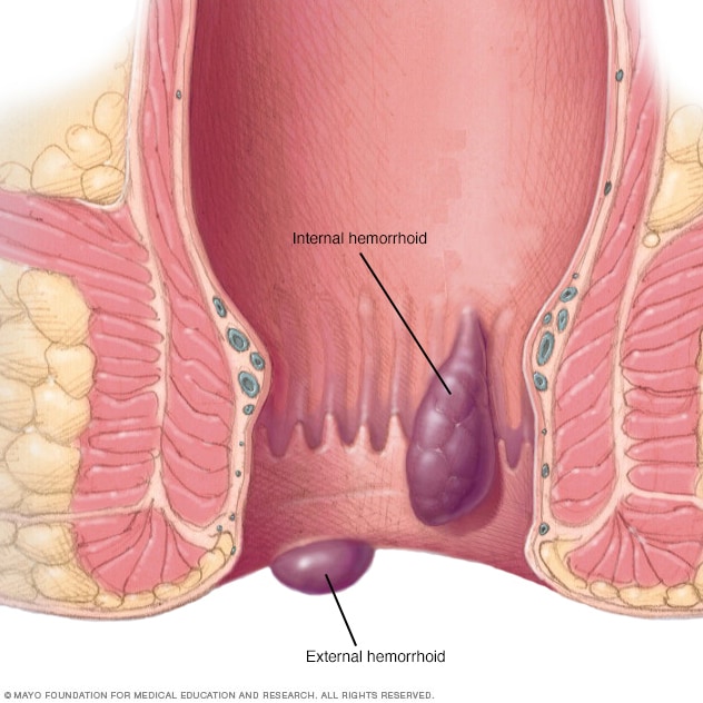 Internal haemorrhoids may cause rectal bleeding but do not usually cause discomfort. External haemorrhoids are more prone to itching and irritation.