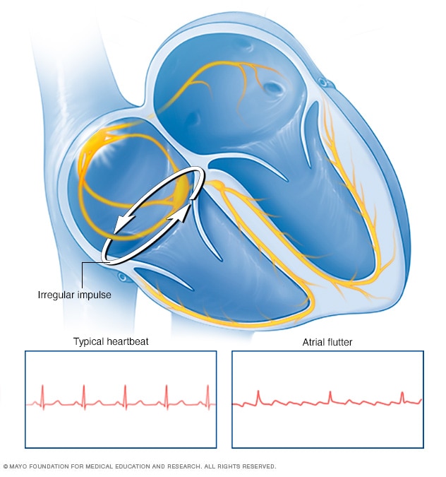 Atrial flutter 