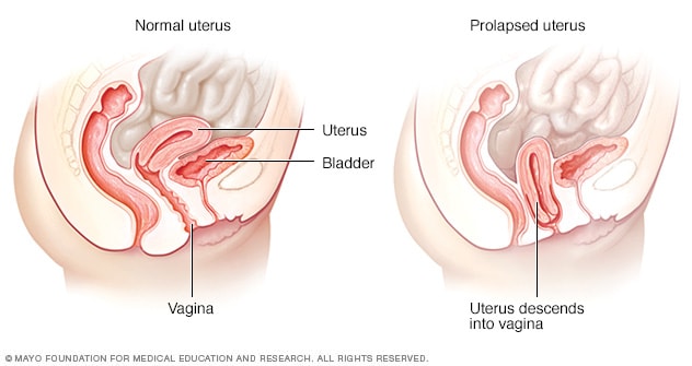 Prolapso Uterino Sintomas Y Causas Mayo Clinic