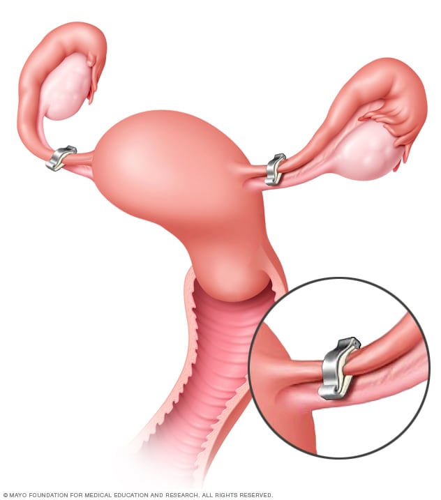 Ligadura De Trompas Mayo Clinic