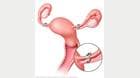 输卵管结扎术 