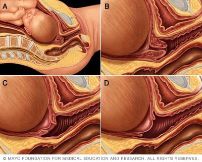 Borramiento y dilatación del cuello del útero 
