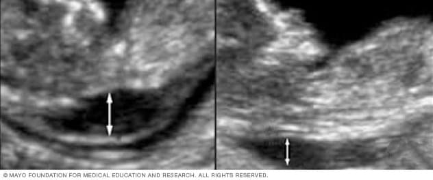 Baby's nuchal translucency measurement 