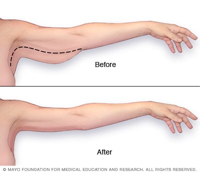 Cirugía de levantamiento de brazo
