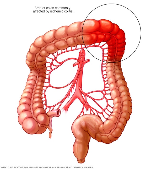 Dónde ocurre la colitis isquémica