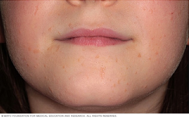 Flat warts