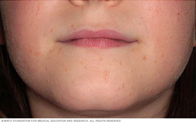 Facial warts hpv type, Human papillomavirus facial warts Human papillomavirus warts on face