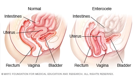 Prolapso del intestino delgado (enterocele)