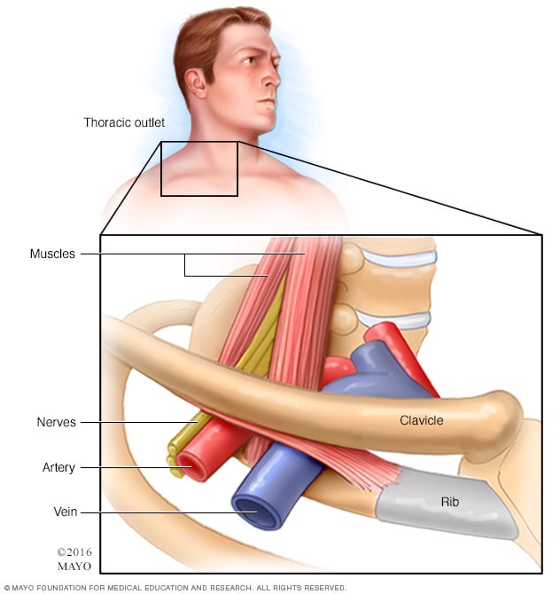 Thoracic outlet syndrome - Symptoms and causes - Mayo Clinic