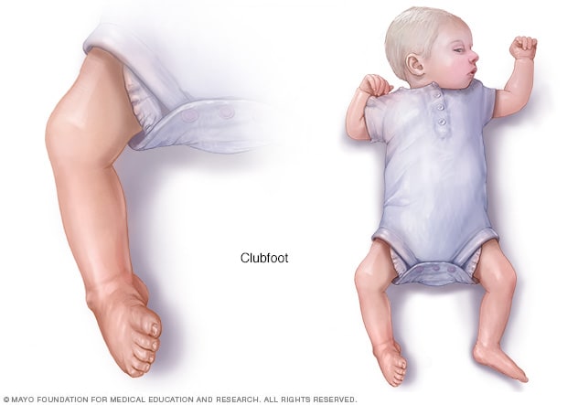 Image result for clubfoot causes, symptoms & treatments