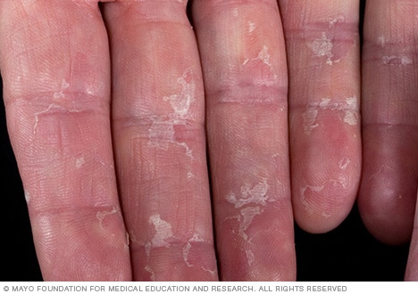 File:Peeled skin from infection.jpg - Wikipedia