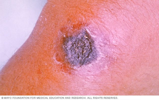 An infection of cutaneous anthrax in a person's skin