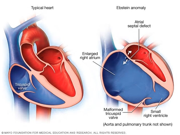 Ebstein Anomaly Symptoms And Causes Mayo Clinic