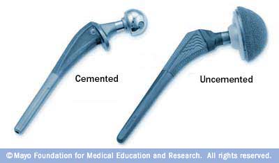 Imagen de un implante de articulación de cadera cementado y uno no cementado 
