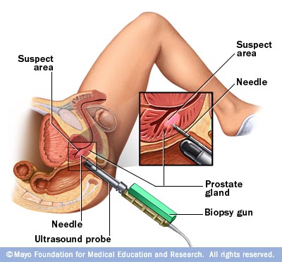 Ilustración de una biopsia por punción de próstata guiada por imágenes 
