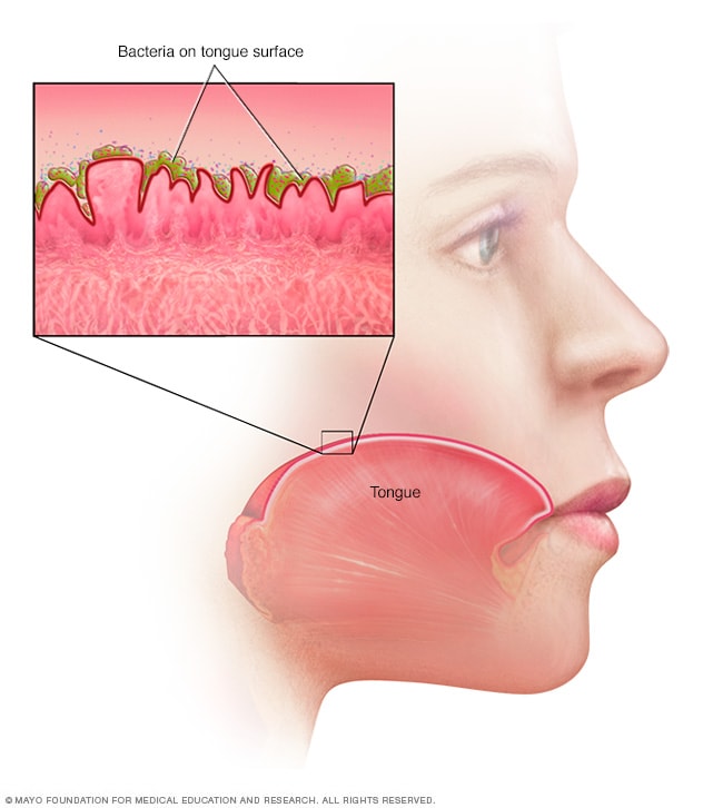 Bacteria on the tongue surface 