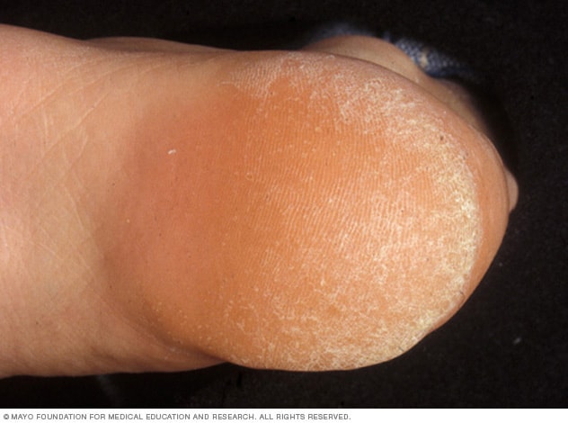 painful callus on bottom of heel