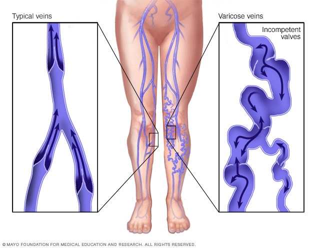 Image of comparison between normal vein and vein with Varicose disorder