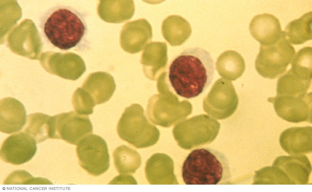 خلايا ابيضاض الدم (اللوكيميا) مُشعر الخلايا تحت المجهر