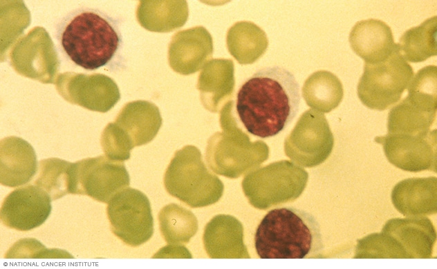 Células de tricoleucemia bajo un microscopio