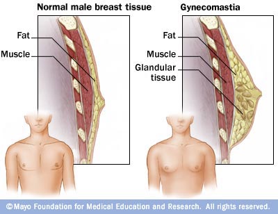Imagen de ginecomastia (aumento en el tamaño de las mamas de los hombres) 