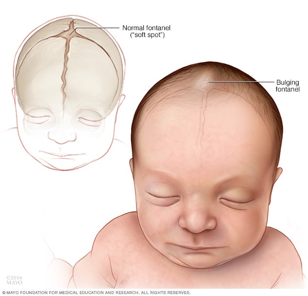 Comparación de puntos blandos (fontanelas) normales y anormales en el cráneo de un bebé