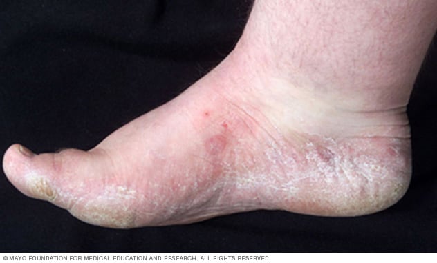 Dead Skin Under Feet: Causes, Symptoms, And Treatment