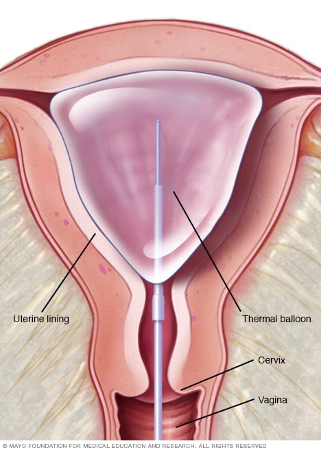 Endometrial ablation experience