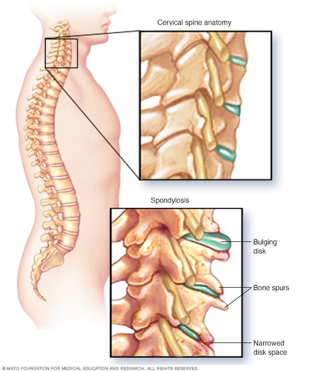 symptoms of spondylolisthesis cervical