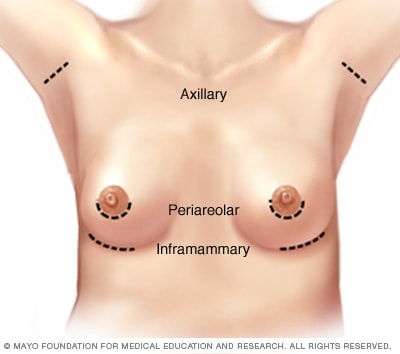 Sitios de incisión para el aumento de mama