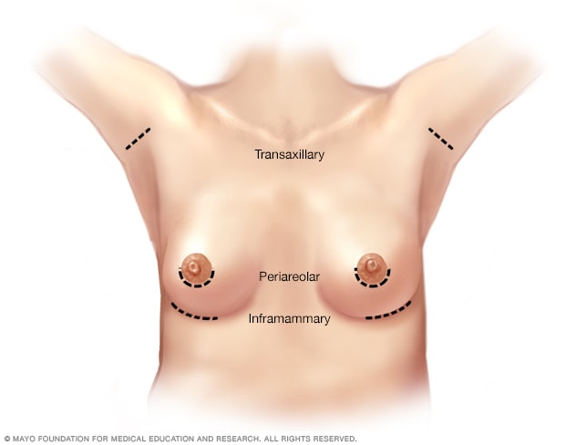 Breast augmentation incision sites