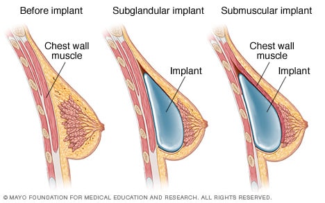 Dr A Trussler Breast Augmentation Surgeon