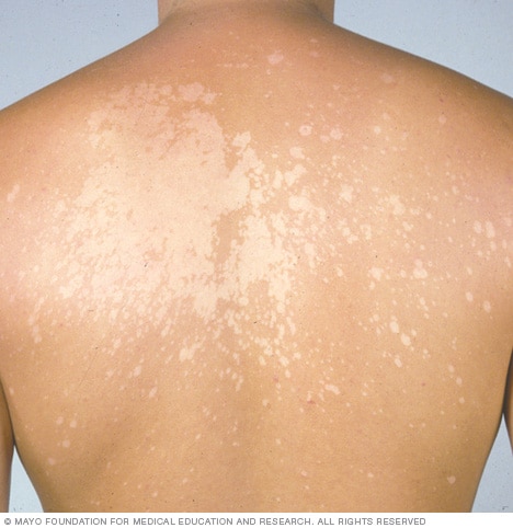  Tinea versicolor - Mayo Clinic