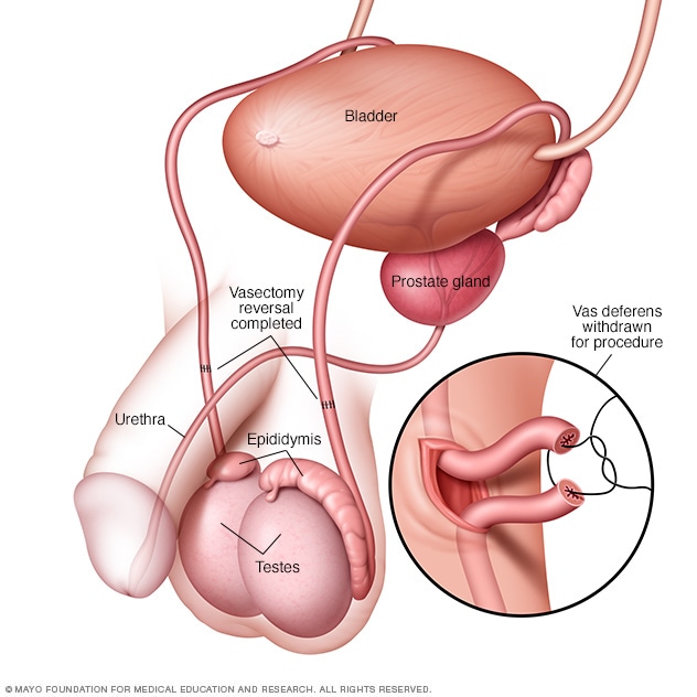 Best of Sperm counts after a vas reversal Excellent porn Big boob cup knock really ta tit