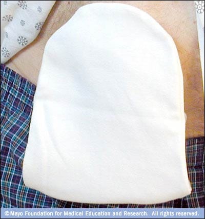 Photograph of man wearing a cover over his ostomy pouch 