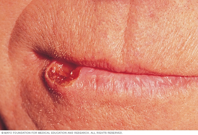 Lip cancer - Mayo Clinic