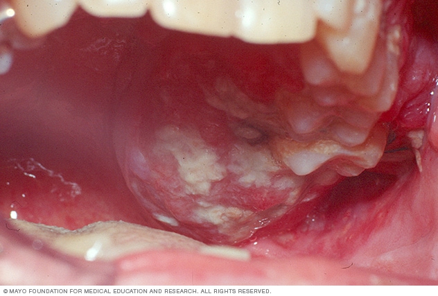 Early Signs Of Mouth Cancer Pictures