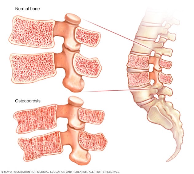 Get screened for osteoporosis using DEXA scans