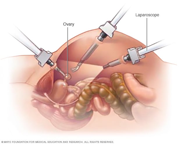Ooforectomía (extirpación quirúrgica de los ovarios) - Mayo Clinic