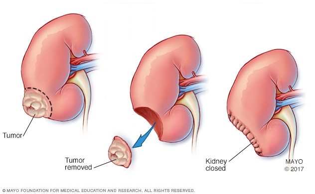 Partial nephrectomy - Mayo Clinic renal cyst diagram 