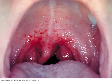 Imagen de una faringitis estreptocócica